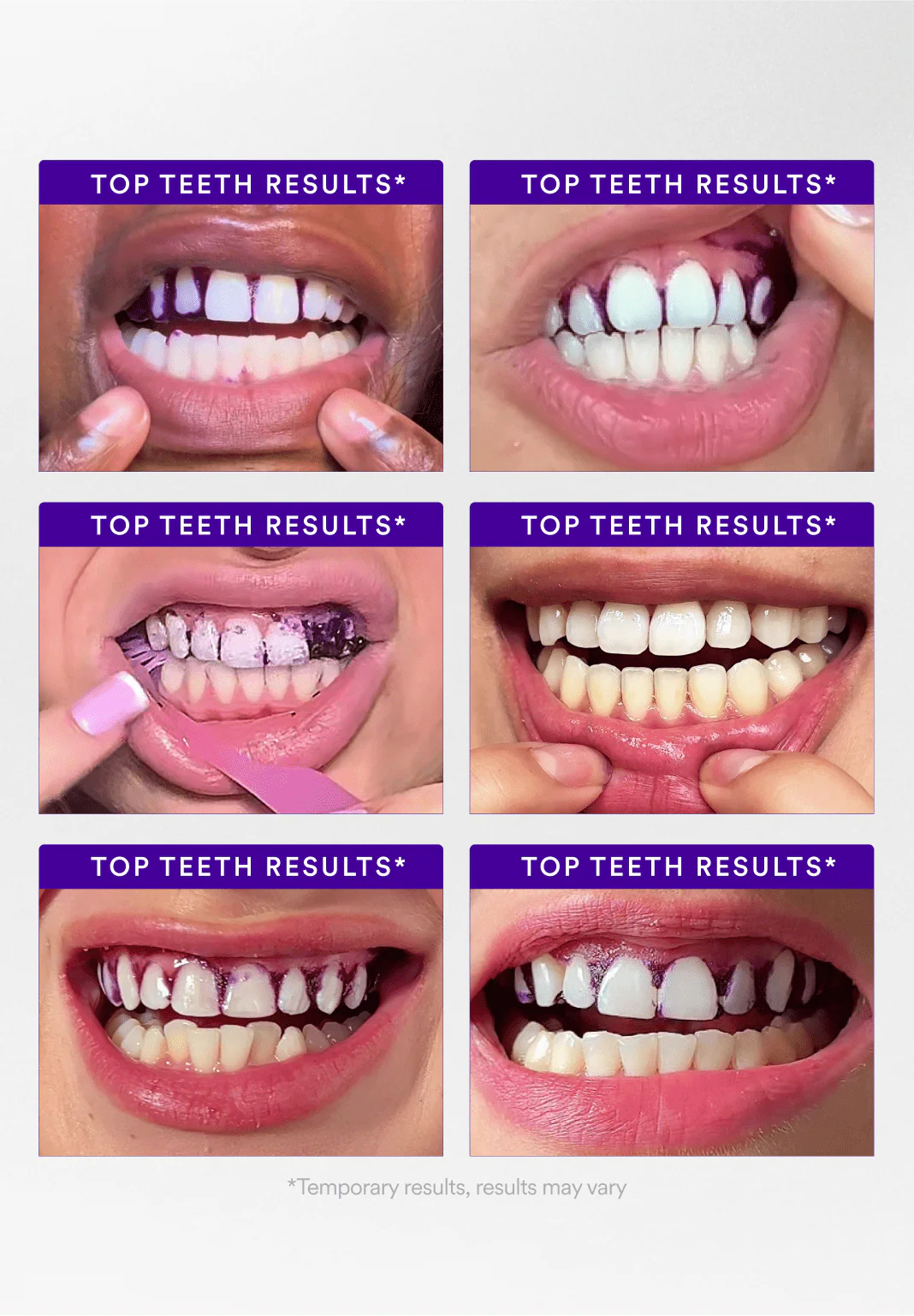 Patchs Blanchissants Oralhoe™ – Sourire éclatant dès la première utilisation ✨