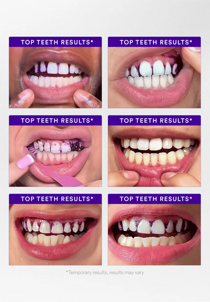 Patchs Blanchissants Oralhoe™ – Sourire éclatant dès la première utilisation ✨